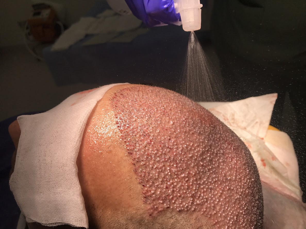 Saç Ekimi Alanında Clinista Saç Ekim Merkezi’nin Liderliği