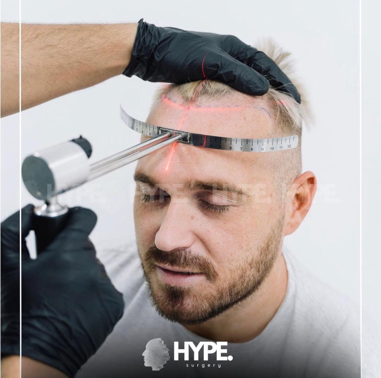 Hype Surgery Saç Ekimi Merkezi: Safir Saç Ekimi ile Daha Doğal ve Estetik Sonuçlar