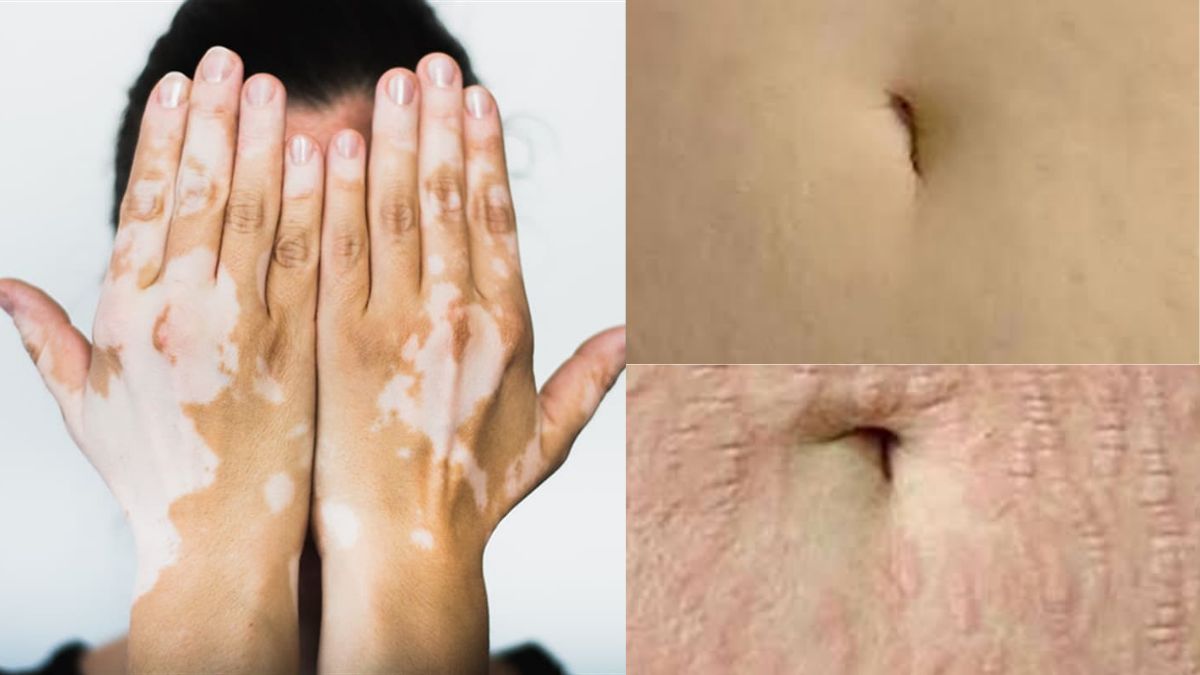 Doğal Cilt Görünümü İçin Medikal Kamuflajda İkbal Yeşil Farkı