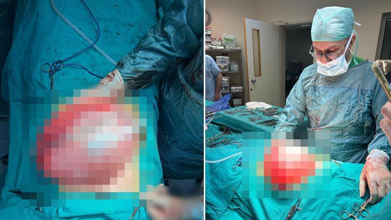 Karın Ağrısıyla Gelen Lise Öğrencisinin Karnından 3,5 Kilo Kist Çıkarıldı